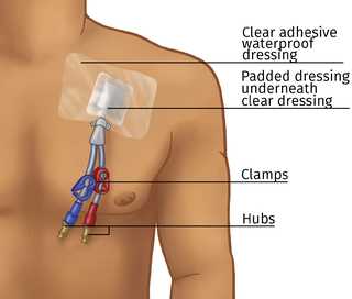 chest-catheter-320by272-78fbc4